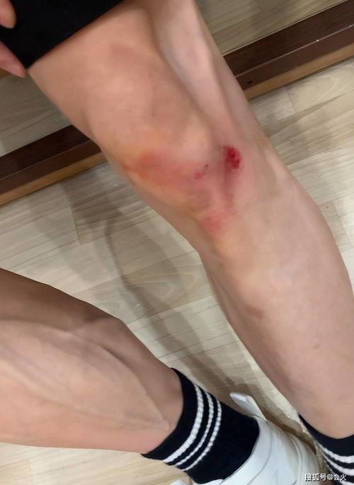 膝盖摔伤照片,运动损伤的警示与康复之道