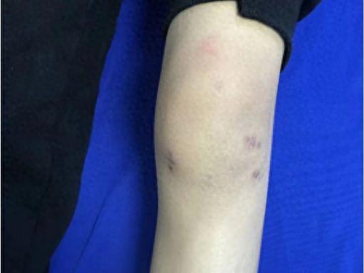 膝盖摔伤照片,运动损伤的警示与康复之道 第3张 膝盖摔伤照片,运动损伤的警示与康复之道 第3张